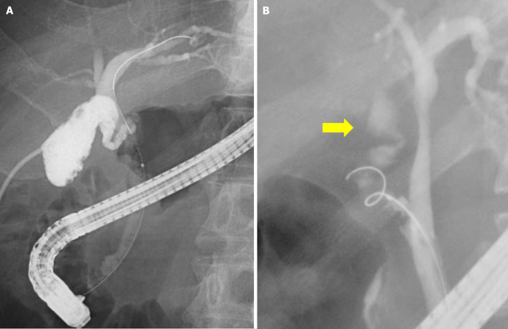 Benefits of endoscopic gallbladder stenting following percutaneous transhepatic gallbladder drainage.