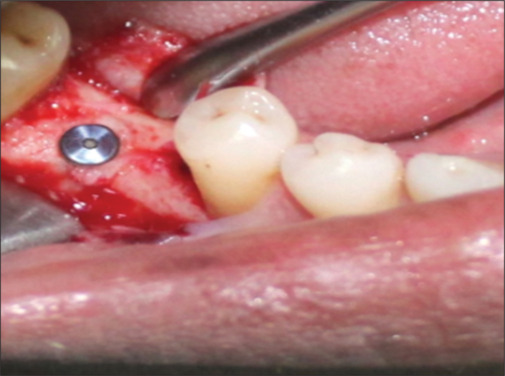 Comparative evaluation of submerged versus nonsubmerged dental implants - A prospective, clinico-radiographic, split-mouth study.