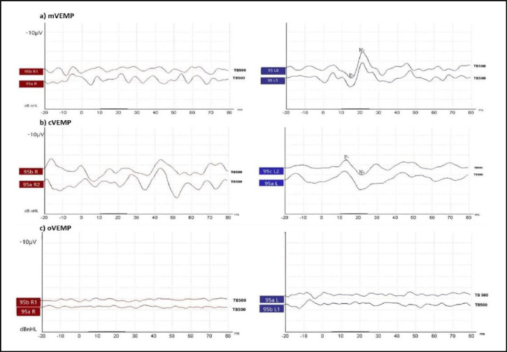 Masseteric Vestibular Evoked Myogenic Potentials in Vestibular Neuritis: A Case Series.
