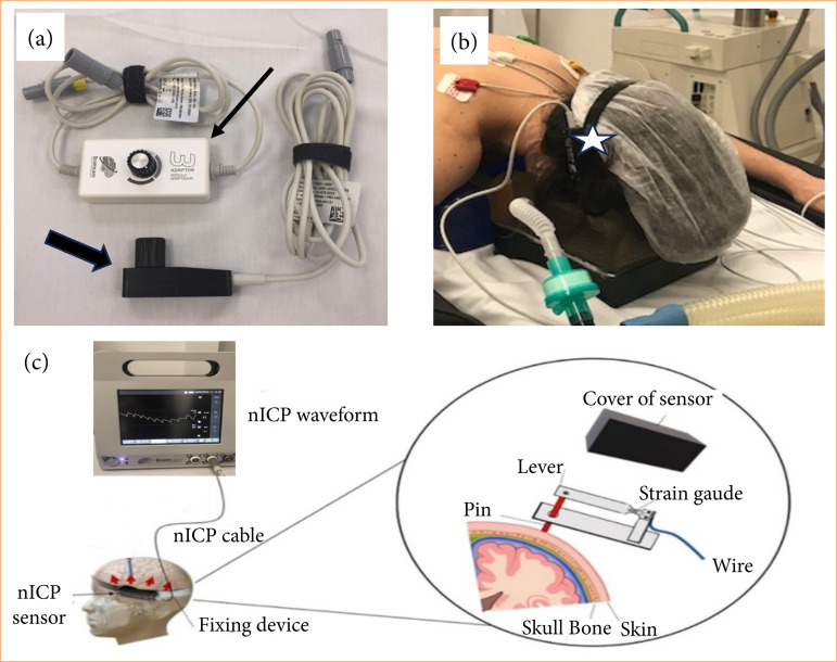 Noninvasive intracranial pressure profile in 31 patients submitted to fullendoscopic spine surgery.