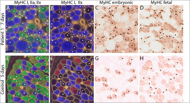 Abnormal expression of myosin heavy chains in early postnatal stages of spinal muscular atrophy type I at single fibre level.