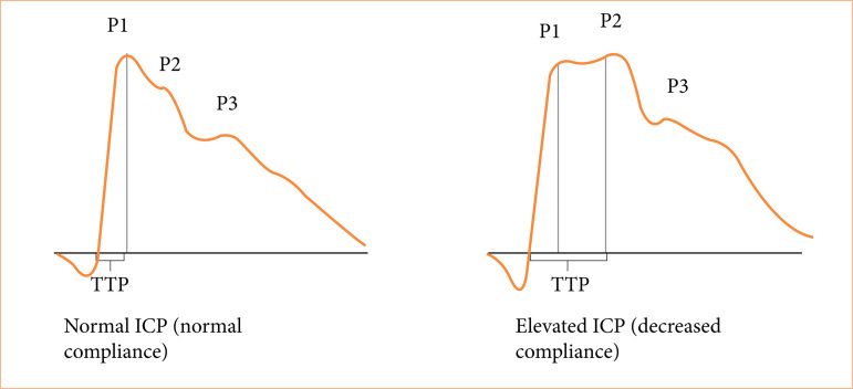 Noninvasive intracranial pressure profile in 31 patients submitted to fullendoscopic spine surgery.