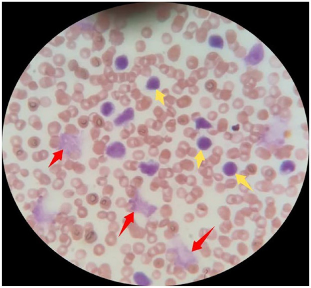 Chilaiditi's Sign: A Rare Finding in a Patient with Concurrent Liver Cirrhosis and Chronic Lymphocytic Leukemia.