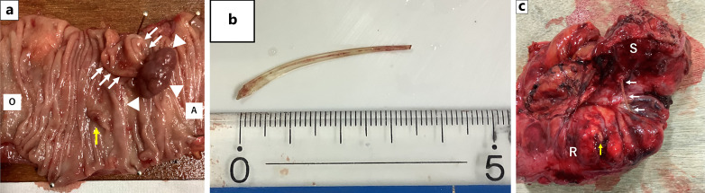 Colonic Fishbone-Induced Perforation Involving a Penile Colorectal Carcinoma: A Case Report.