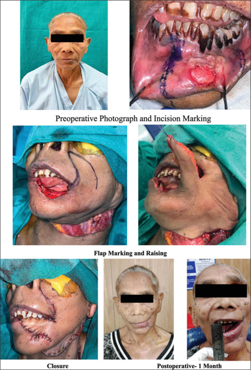 Comparative evaluation of postoperative functional and esthetic outcomes for lip reconstruction with Fujimori gate flap versus Abbe-Estlander flap in patients being operated for oral squamous cell carcinoma.