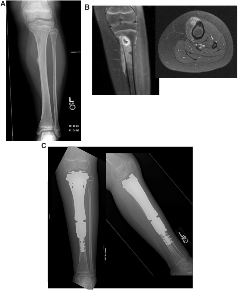 Proximal Tibia Hemiarthroplasty Reconstruction Following Resection of Malignant Bone Tumors in Skeletally Immature Patients.