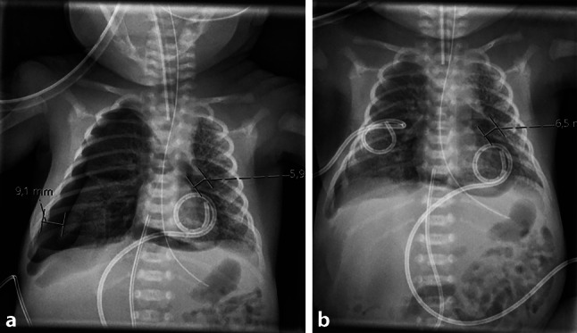 Something is up in the air: pneumothorax and pneumopericardium in a 29-week preterm infant.