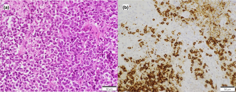 Autopsy case of cardiac mantle cell lymphoma presenting with recurrent pulmonary tumor embolism after chemotherapy.