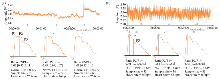 Noninvasive intracranial pressure profile in 31 patients submitted to fullendoscopic spine surgery.