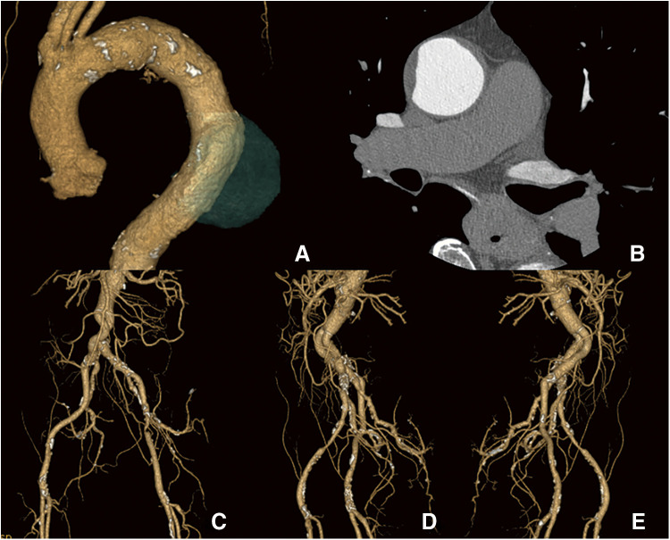 A Case of Transapical Thoracic Endovascular Repair for Thoracic Aortic Aneurysm with a Complicated Access Route.