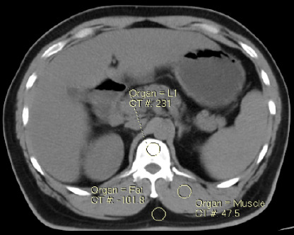 The Impact of Contrast Media on Lumbar Spine Bone Mineral Density Measured by Quantitative Computed Tomography.