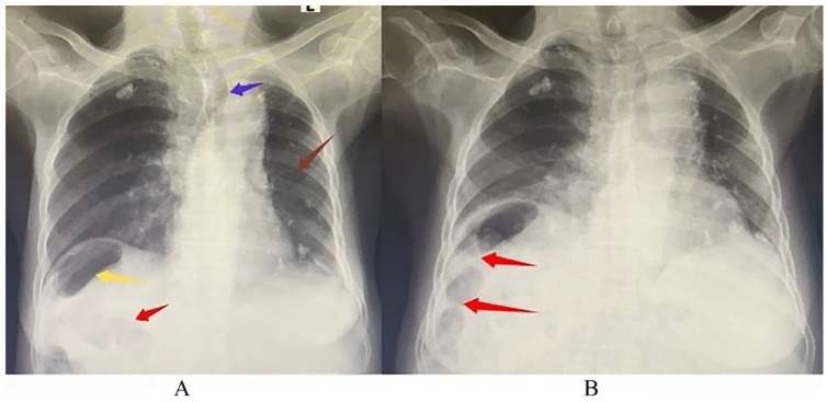 Chilaiditi's Sign: A Rare Finding in a Patient with Concurrent Liver Cirrhosis and Chronic Lymphocytic Leukemia.