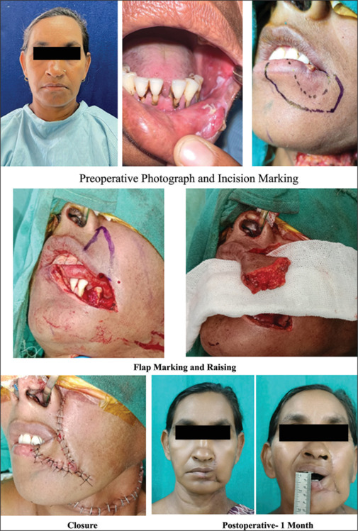 Comparative evaluation of postoperative functional and esthetic outcomes for lip reconstruction with Fujimori gate flap versus Abbe-Estlander flap in patients being operated for oral squamous cell carcinoma.