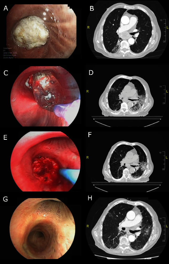 Malignant Airway Stenosis Successfully Treated Using a Combination of Interventional Pulmonology, Chemotherapy, and Radiotherapy.