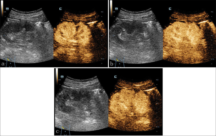 Multimodal imaging findings of tubulocystic renal cell carcinoma: A case report.