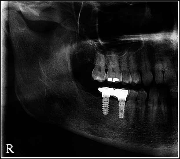 Long-term follow-up of a large multilocular odontogenic keratocyst. Analysis of recurrences and the applied treatments.
