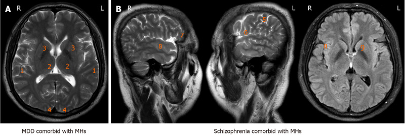 Classification of musical hallucinations and the characters along with neural-molecular mechanisms of musical hallucinations associated with psychiatric disorders.