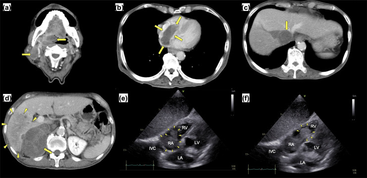 Autopsy case of cardiac mantle cell lymphoma presenting with recurrent pulmonary tumor embolism after chemotherapy.