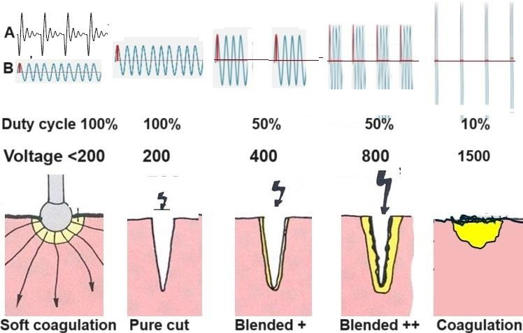 Electrosurgery: heating, sparking and electrical arcs.