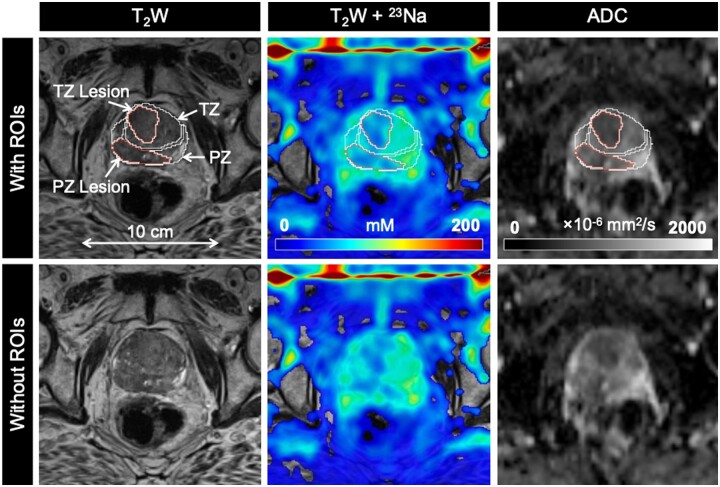 Different sodium concentrations of noncancerous and cancerous prostate tissue seen on MRI using an external coil.