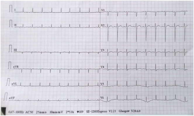 Chilaiditi's Sign: A Rare Finding in a Patient with Concurrent Liver Cirrhosis and Chronic Lymphocytic Leukemia.