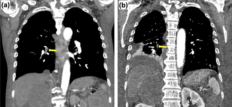 Autopsy case of cardiac mantle cell lymphoma presenting with recurrent pulmonary tumor embolism after chemotherapy.