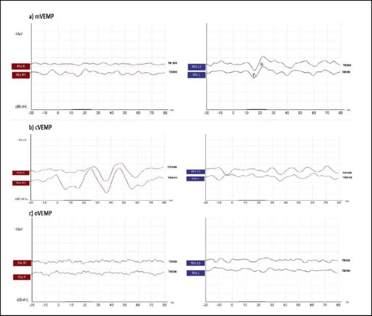 Masseteric Vestibular Evoked Myogenic Potentials in Vestibular Neuritis: A Case Series.