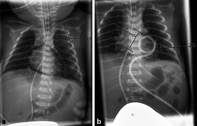 Something is up in the air: pneumothorax and pneumopericardium in a 29-week preterm infant.
