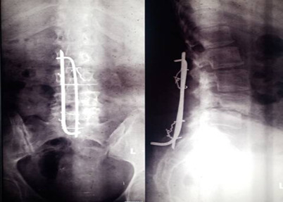 Long-term Clinical Outcomes of Posterior Spinal Stabilization Using Adeolu's Technique: A Prospective Study from Nigeria.