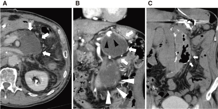 A Case of Infected Abdominal Aortic Graft with Pancreatic Fistula: Successful Treatment through a Staged Approach with Percutaneous Catheter Drainage and Partial Graft Excision.