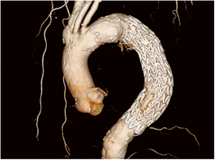 A Case of Transapical Thoracic Endovascular Repair for Thoracic Aortic Aneurysm with a Complicated Access Route.