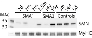 Abnormal expression of myosin heavy chains in early postnatal stages of spinal muscular atrophy type I at single fibre level.