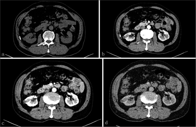 Multimodal imaging findings of tubulocystic renal cell carcinoma: A case report.