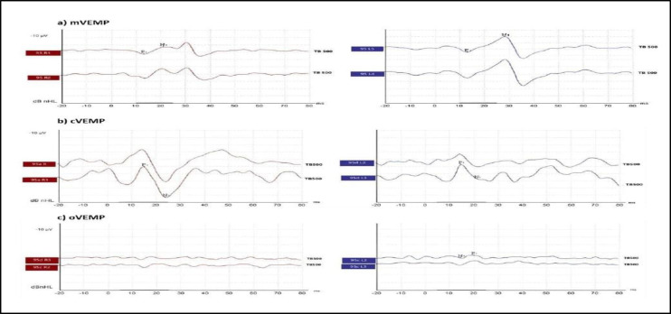 Masseteric Vestibular Evoked Myogenic Potentials in Vestibular Neuritis: A Case Series.
