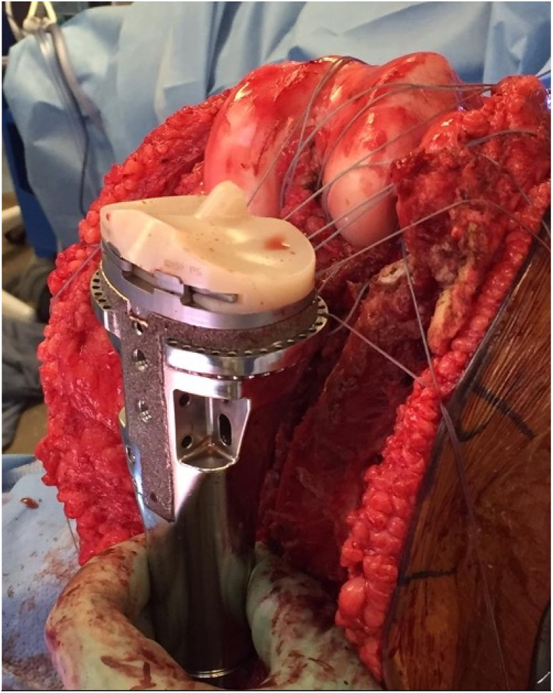 Proximal Tibia Hemiarthroplasty Reconstruction Following Resection of Malignant Bone Tumors in Skeletally Immature Patients.