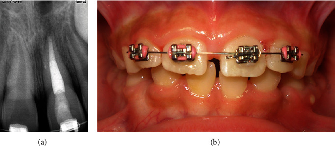 Utility of Orthodontic Braces as Flexible Splint for Stabilizing an Avulsed Tooth: A Case Report.