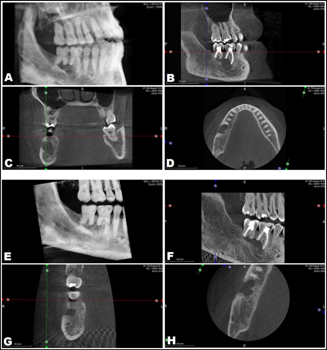Long-term follow-up of a large multilocular odontogenic keratocyst. Analysis of recurrences and the applied treatments.