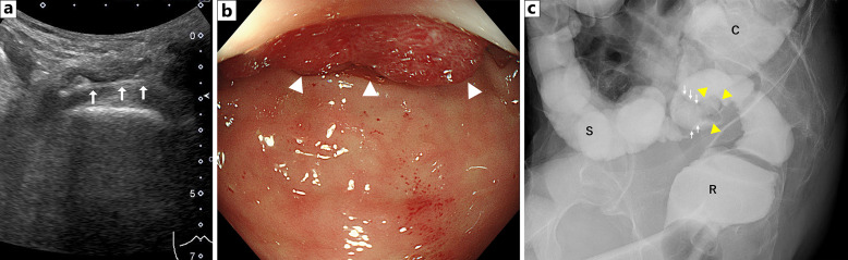 Colonic Fishbone-Induced Perforation Involving a Penile Colorectal Carcinoma: A Case Report.