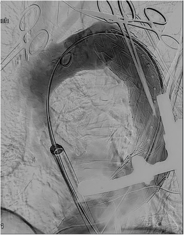 A Case of Transapical Thoracic Endovascular Repair for Thoracic Aortic Aneurysm with a Complicated Access Route.