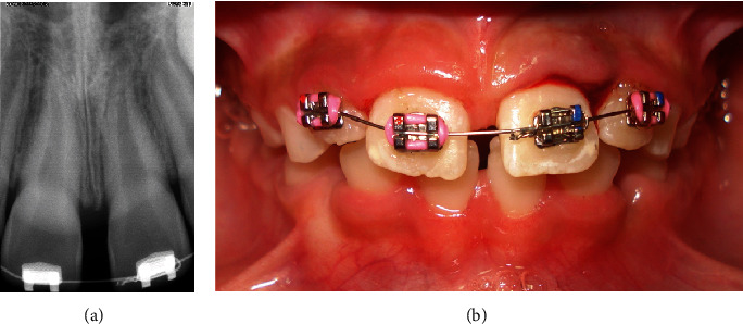 Utility of Orthodontic Braces as Flexible Splint for Stabilizing an Avulsed Tooth: A Case Report.