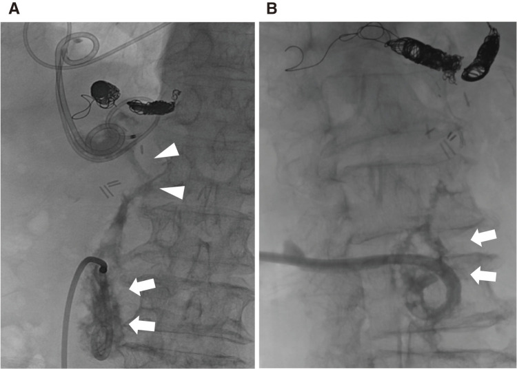 A Case of Infected Abdominal Aortic Graft with Pancreatic Fistula: Successful Treatment through a Staged Approach with Percutaneous Catheter Drainage and Partial Graft Excision.