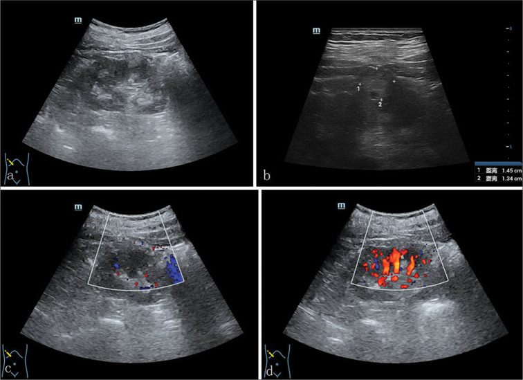 Multimodal imaging findings of tubulocystic renal cell carcinoma: A case report.