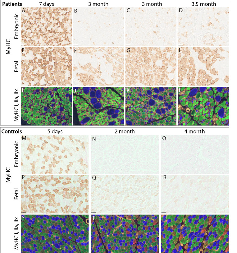 Abnormal expression of myosin heavy chains in early postnatal stages of spinal muscular atrophy type I at single fibre level.