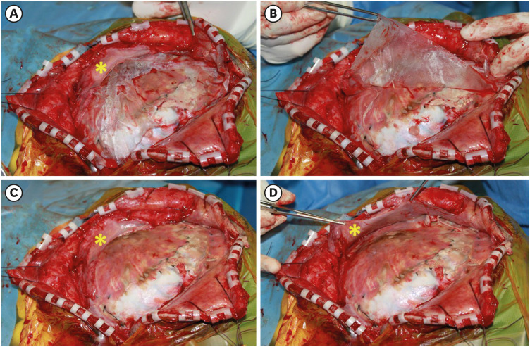 Letter to the Editor: Commentary on Unseparated Temporal Muscle and Duramater Cranioplasty Methods Following Decompressive Craniectomy: Technical Note (<i>Korean J Neurotrauma</i> 2024;20:101-107).