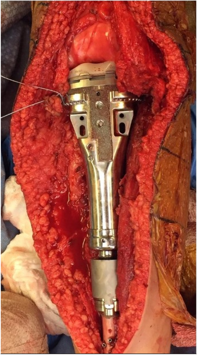 Proximal Tibia Hemiarthroplasty Reconstruction Following Resection of Malignant Bone Tumors in Skeletally Immature Patients.