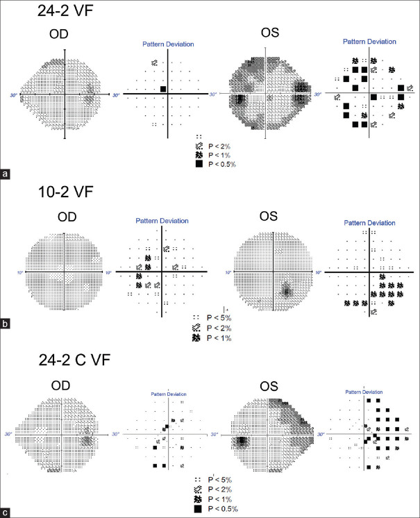 Central visual field in glaucoma: An updated review.