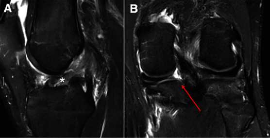Acute Bilateral Posterior Meniscal Root Tears in the Setting of a Noncontact Anterior Cruciate Ligament Rupture.