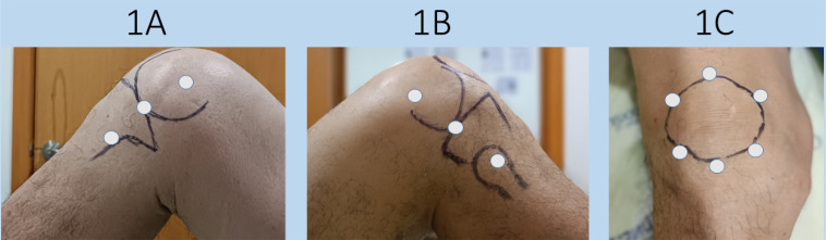 Biopuncture, A Multitarget Therapy in the Treatment of Individuals with Knee Osteoarthritis: state of the art.