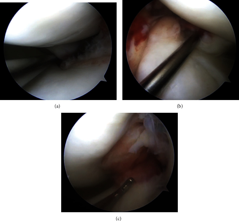 Acute Bilateral Posterior Meniscal Root Tears in the Setting of a Noncontact Anterior Cruciate Ligament Rupture.