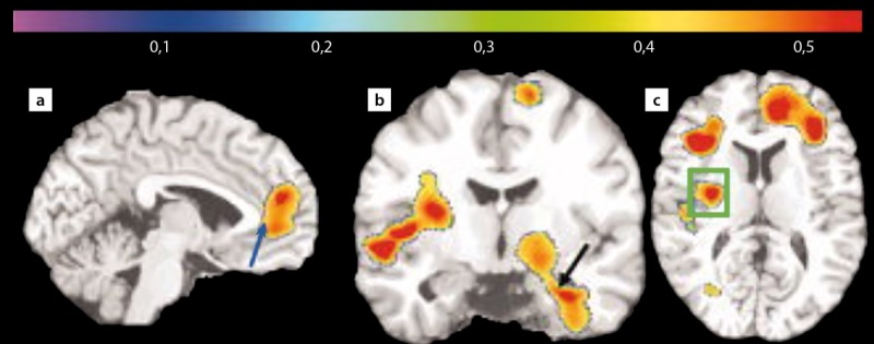 [Cognitive impairment in patients with obesity and impaired carbohydrate metabolism (dysglycemia)].